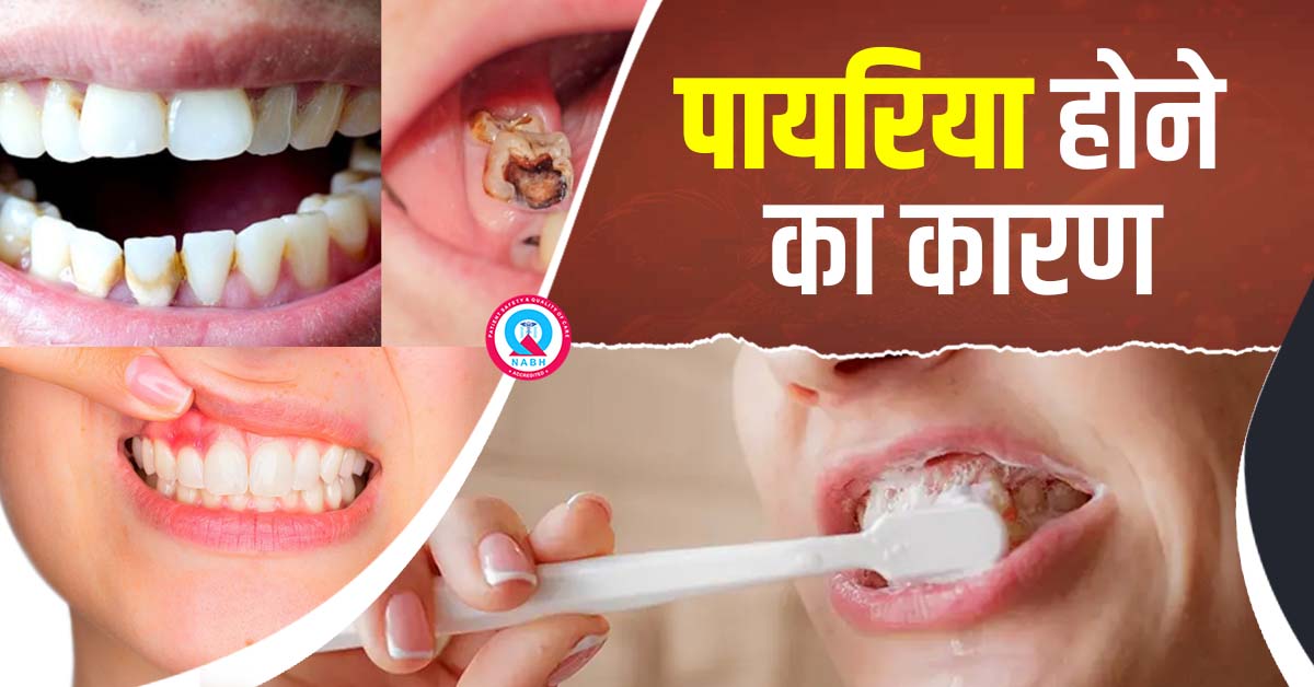 पायरिया होने का कारण